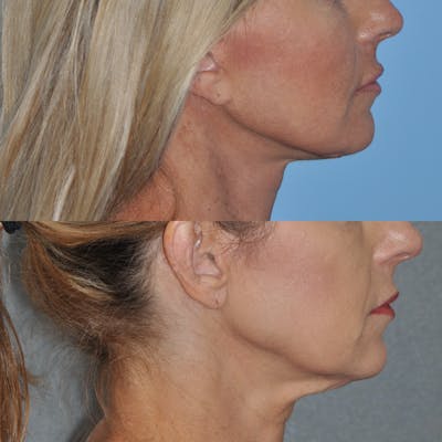 Facelift Before & After Gallery - Patient 59047940 - Image 2