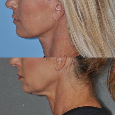Facelift Before & After Gallery - Patient 59047940 - Image 4
