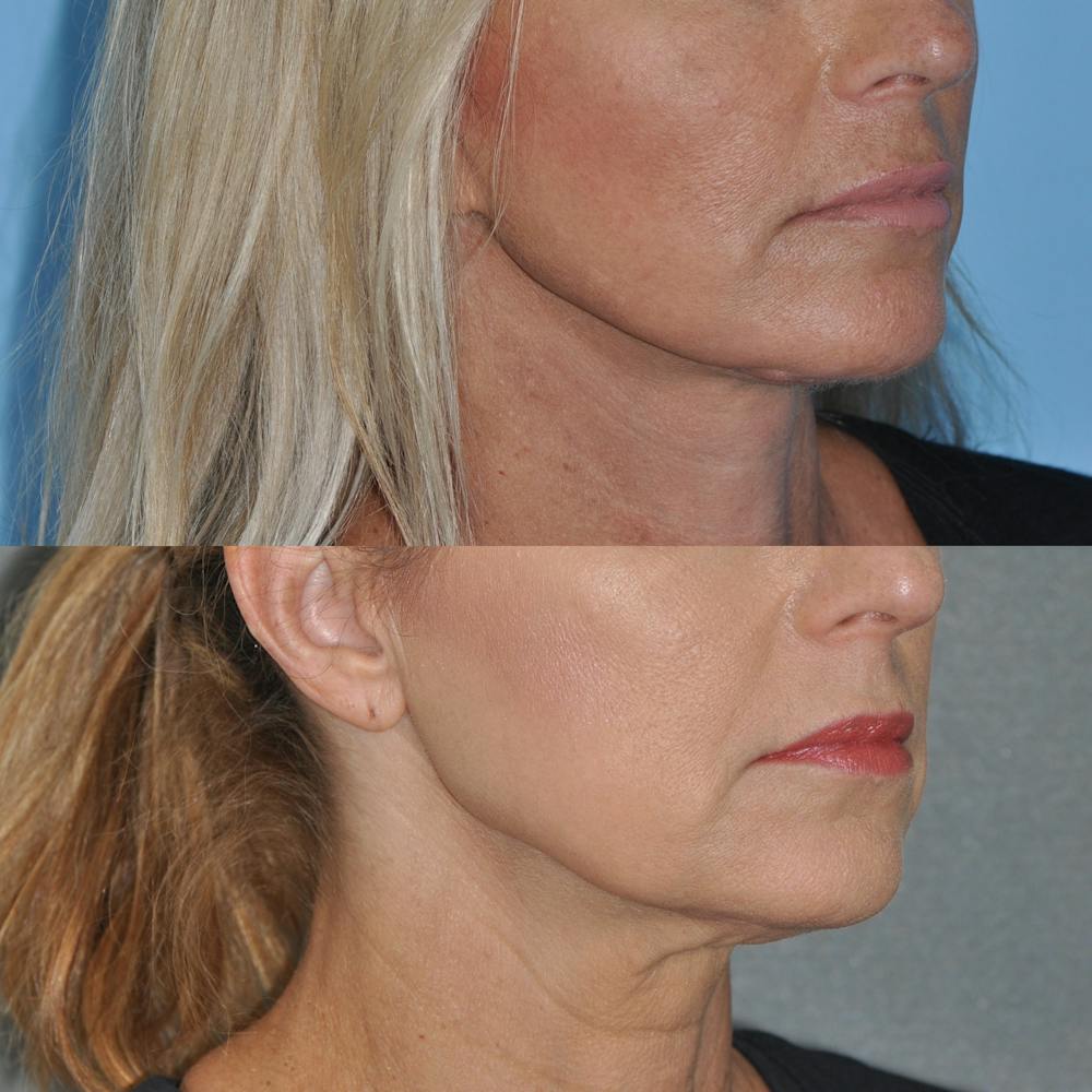 Facelift Before & After Gallery - Patient 59047940 - Image 5