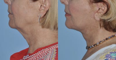 Facelift Before & After Gallery - Patient 59047942 - Image 1