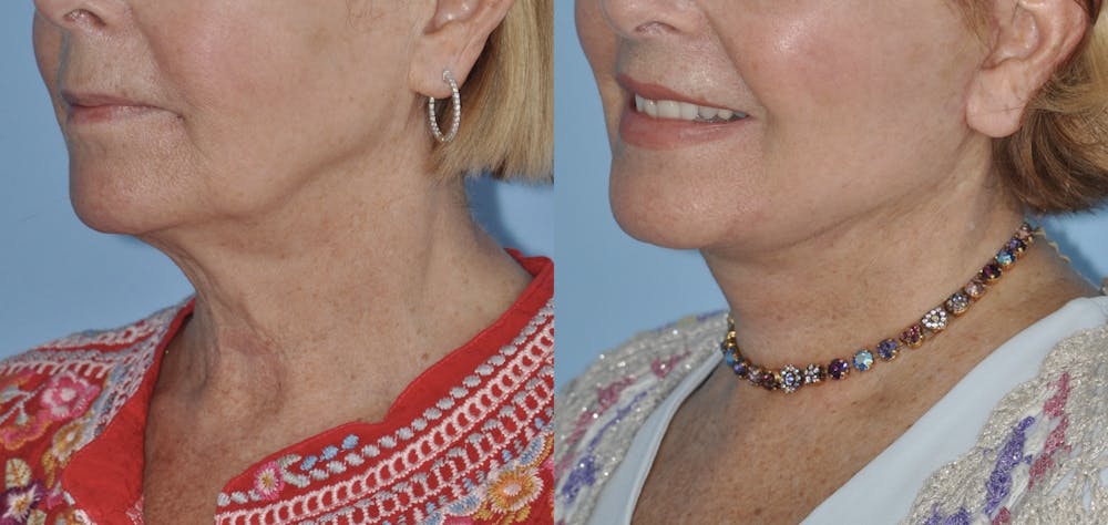 Facelift Before & After Gallery - Patient 59047942 - Image 2