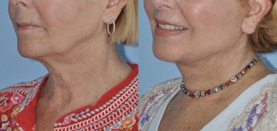 Facelift Before & After Gallery - Patient 59047942 - Image 2