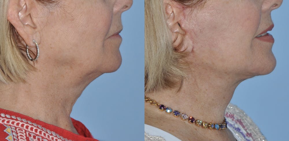 Facelift Before & After Gallery - Patient 59047942 - Image 3