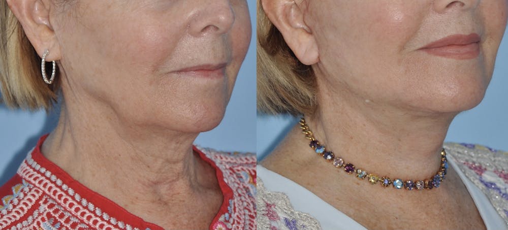 Facelift Before & After Gallery - Patient 59047942 - Image 4