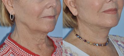 Facelift Before & After Gallery - Patient 59047942 - Image 4