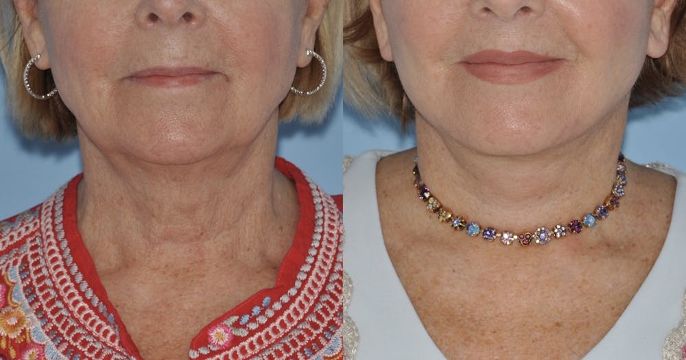 Facelift Before & After Gallery - Patient 59047942 - Image 5