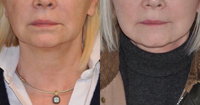 Facelift Before & After Gallery - Patient 59047944 - Image 1