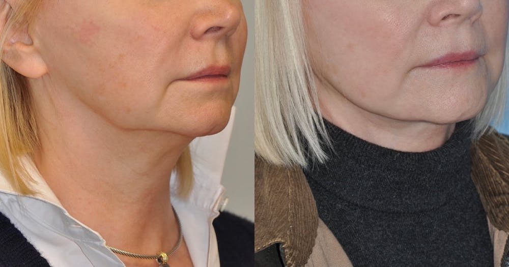 Facelift Before & After Gallery - Patient 59047944 - Image 3
