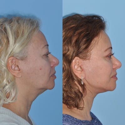 Facelift Before & After Gallery - Patient 59047947 - Image 2