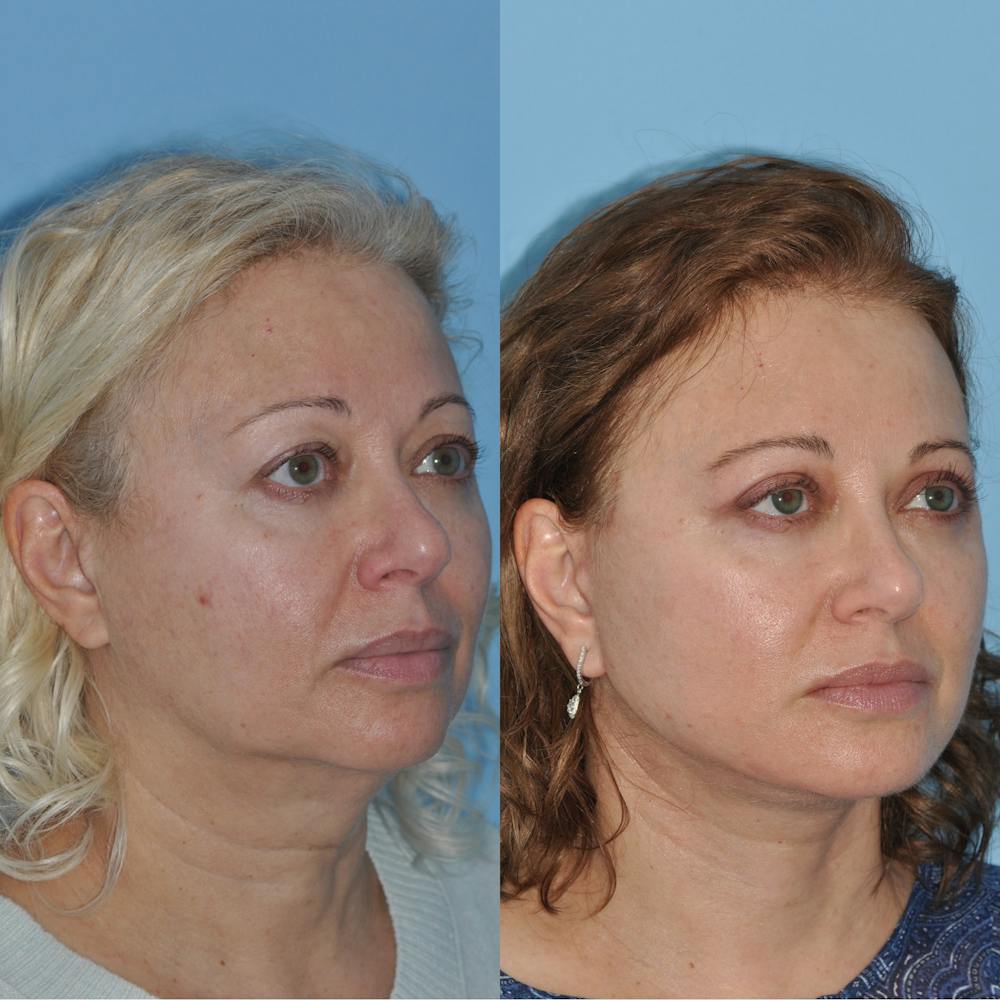 Facelift Before & After Gallery - Patient 59047947 - Image 4
