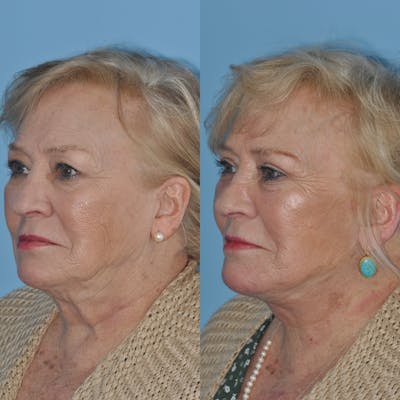 Facelift Before & After Gallery - Patient 59047949 - Image 1
