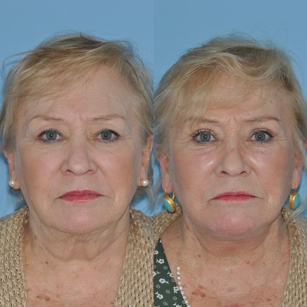 Facelift Before & After Gallery - Patient 59047949 - Image 3