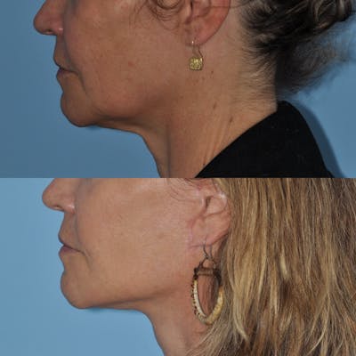 Facelift Before & After Gallery - Patient 59047951 - Image 2