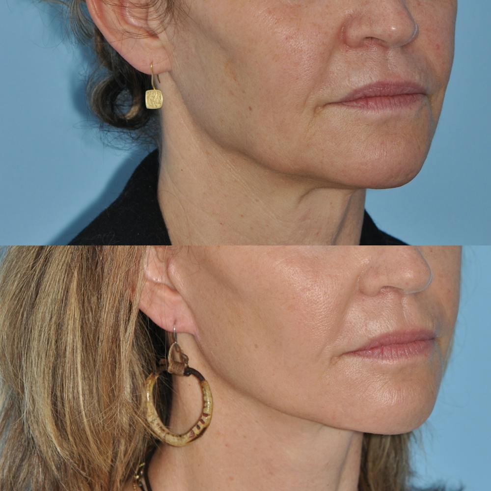Facelift Before & After Gallery - Patient 59047951 - Image 5
