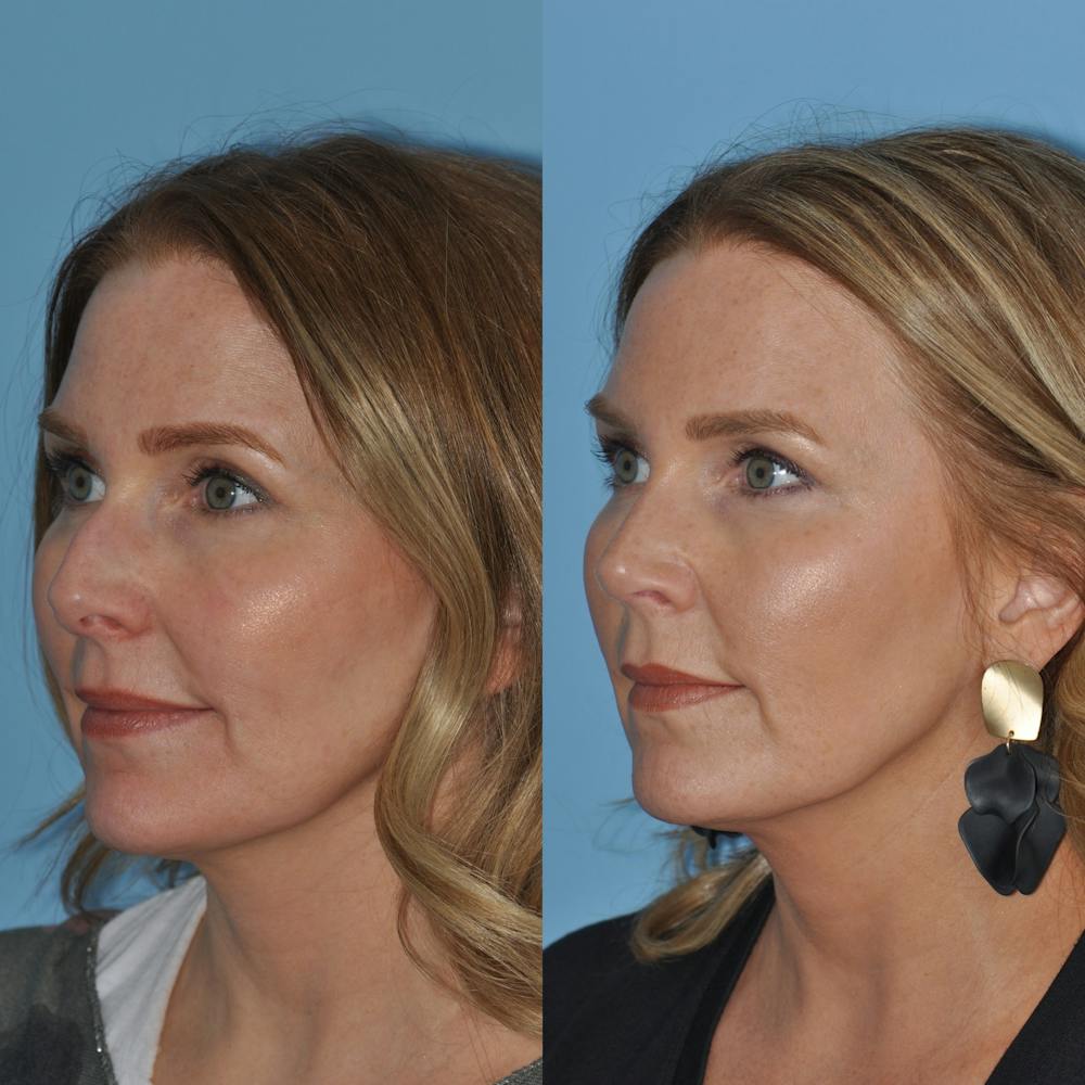 Rhinoplasty Before & After Gallery - Patient 59075279 - Image 1