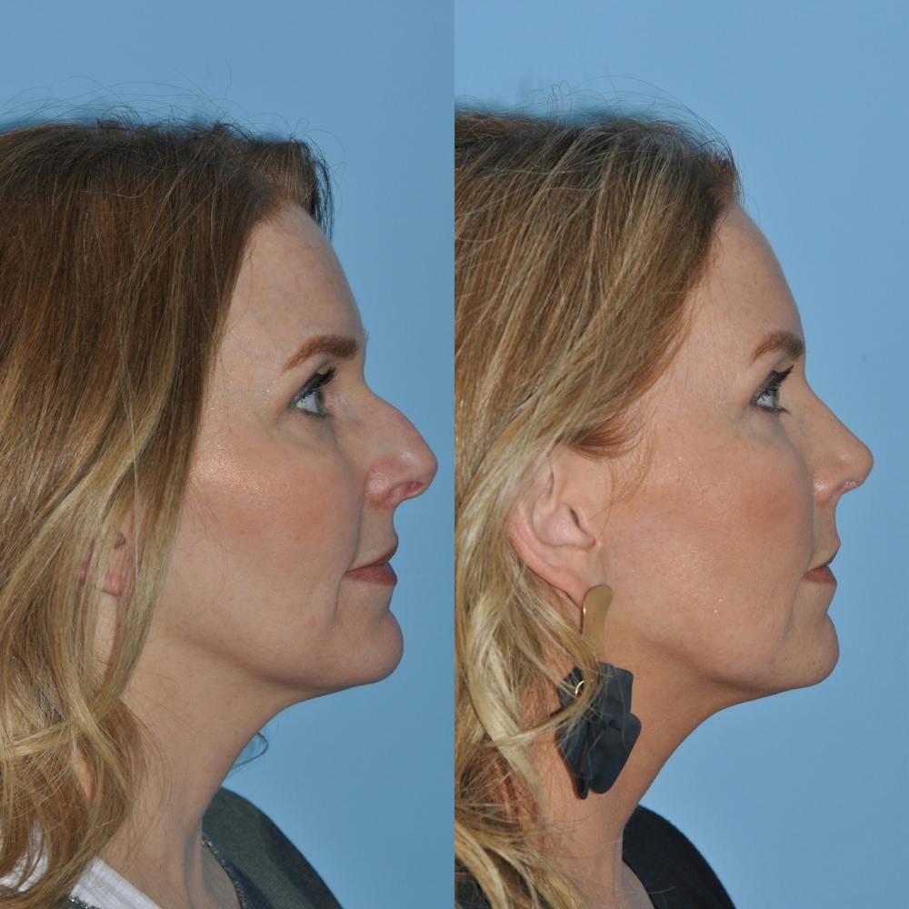 Rhinoplasty Before & After Gallery - Patient 59075279 - Image 2