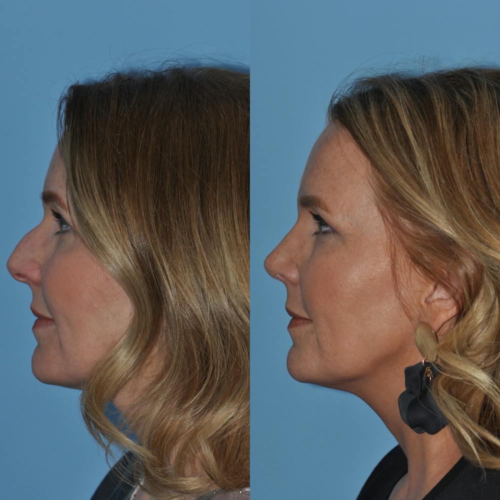 Rhinoplasty Before & After Gallery - Patient 59075279 - Image 3