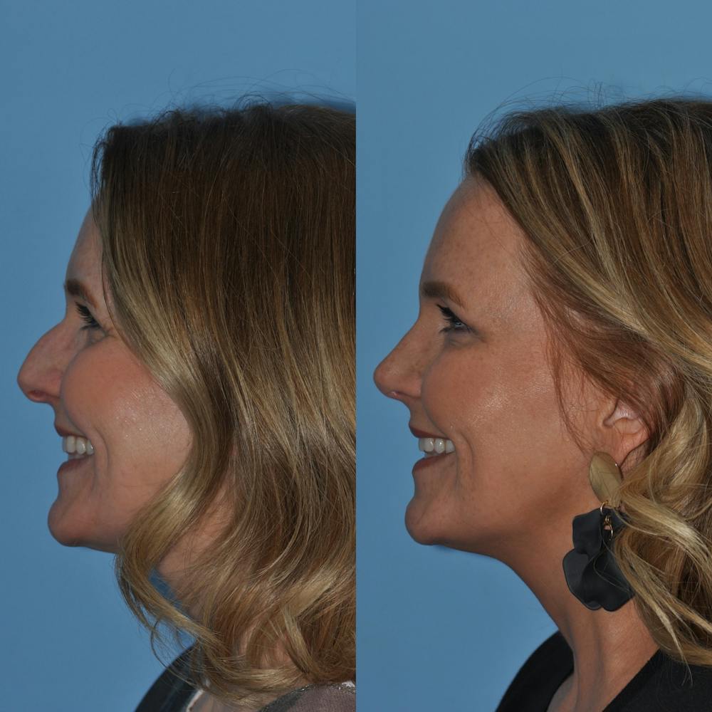 Rhinoplasty Before & After Gallery - Patient 59075279 - Image 4