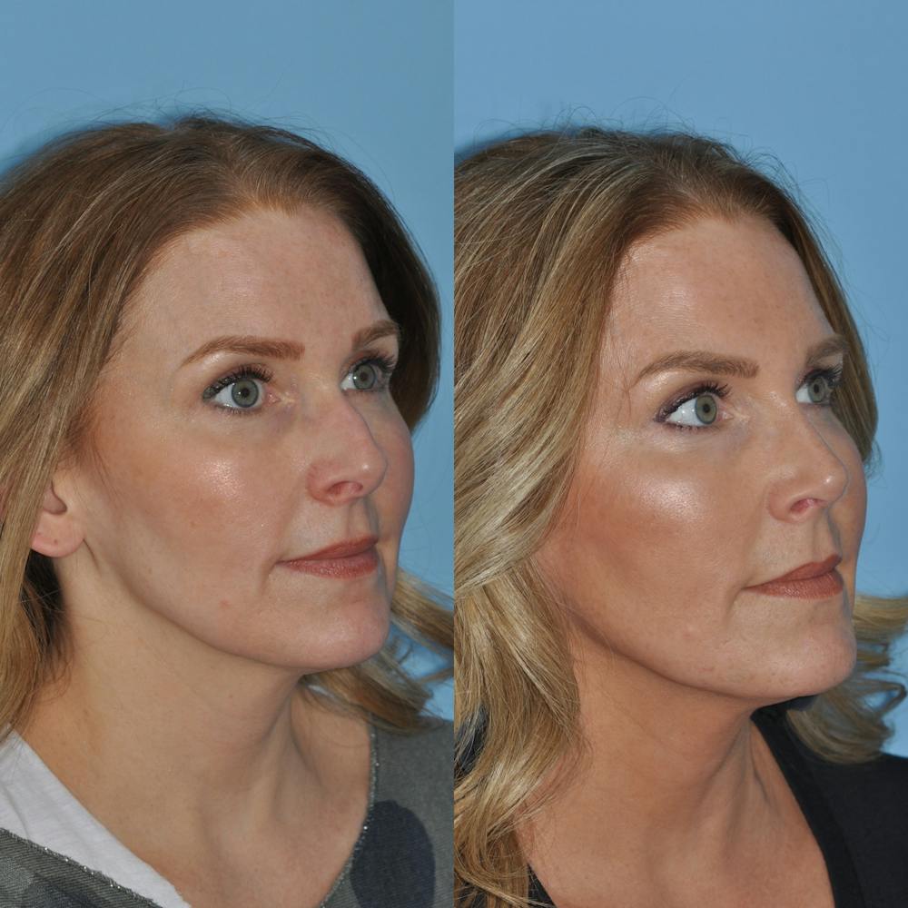 Rhinoplasty Before & After Gallery - Patient 59075279 - Image 5