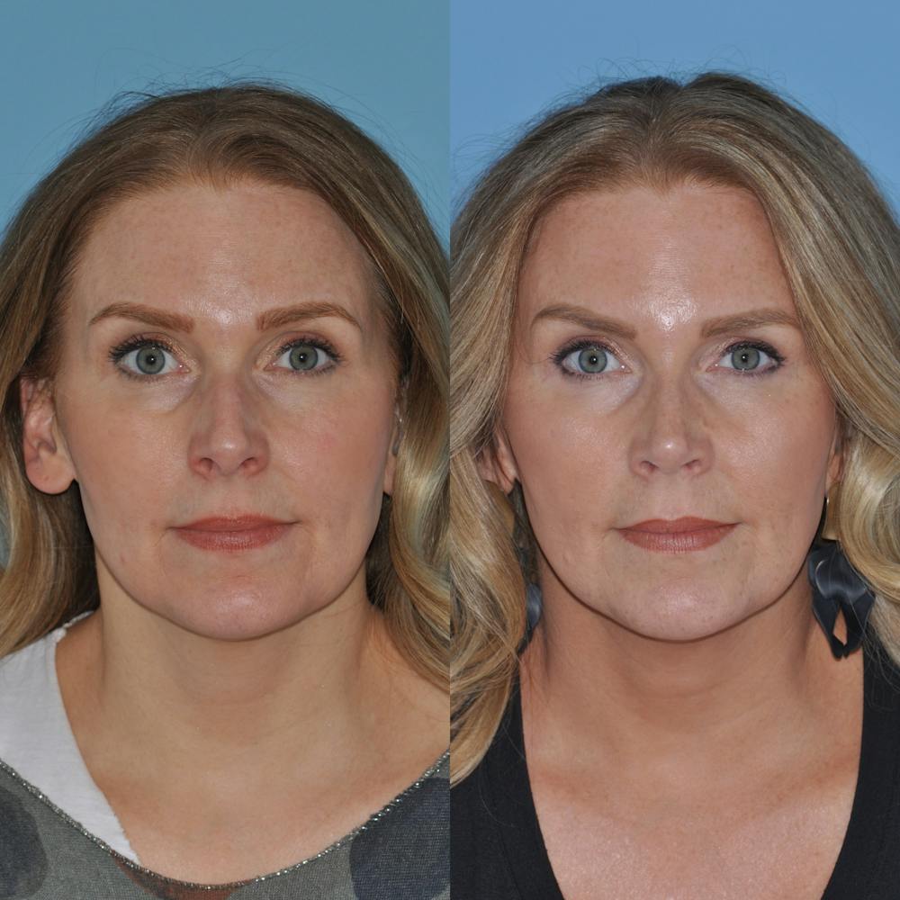 Rhinoplasty Before & After Gallery - Patient 59075279 - Image 6