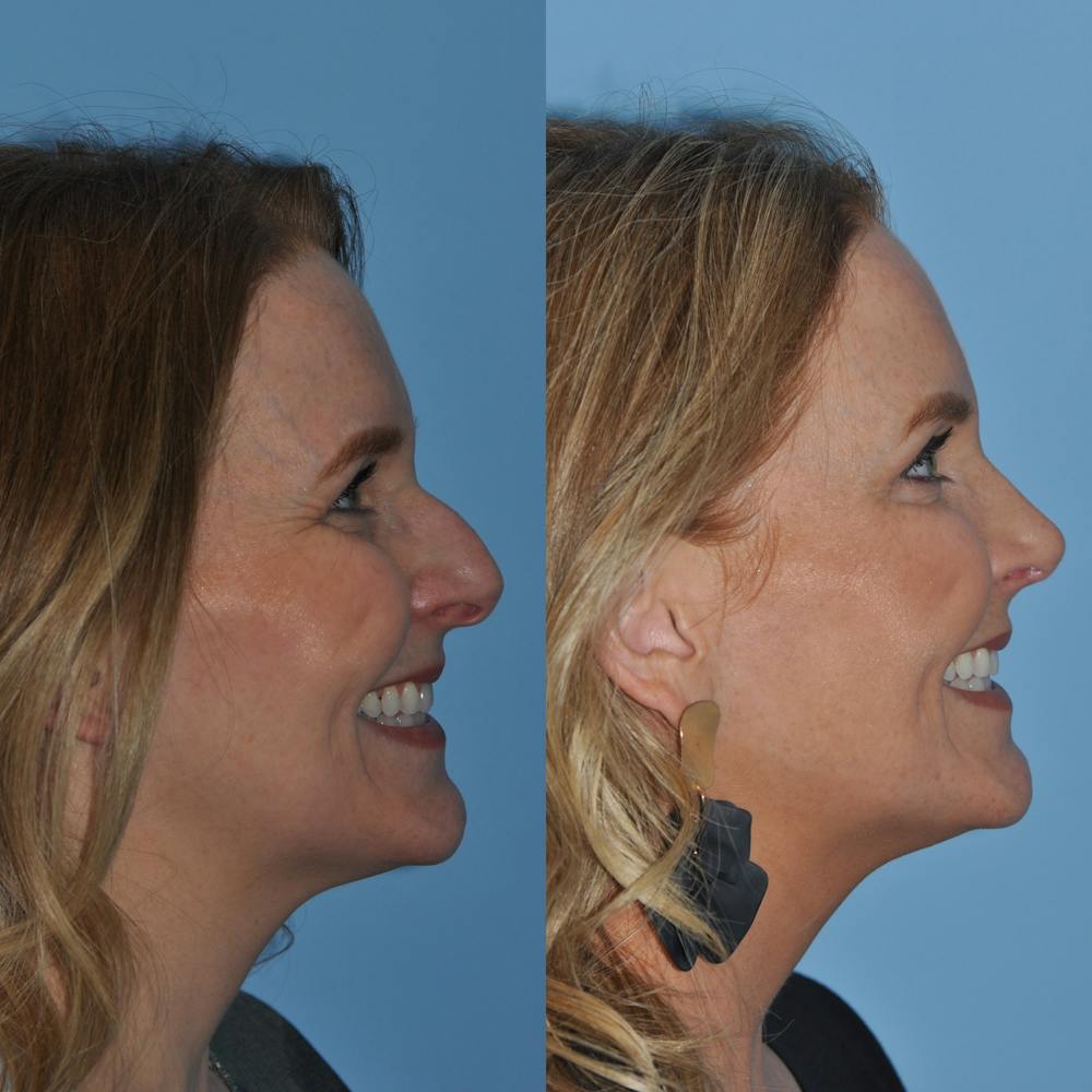 Rhinoplasty Before & After Gallery - Patient 59075279 - Image 7