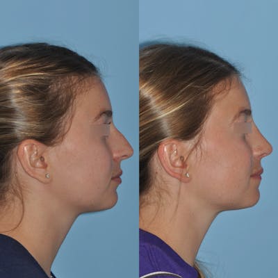 Rhinoplasty Before & After Gallery - Patient 59075280 - Image 2