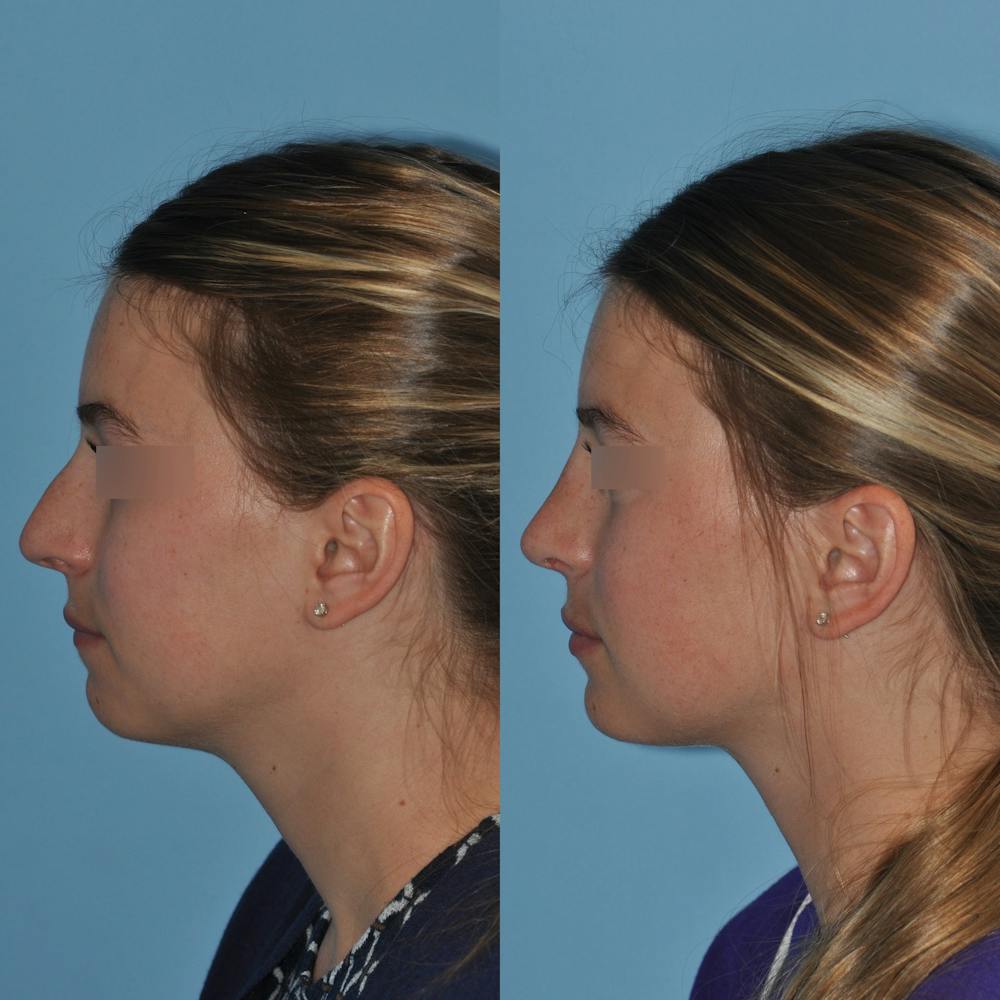 Rhinoplasty Before & After Gallery - Patient 59075280 - Image 3