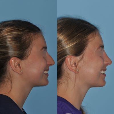 Rhinoplasty Before & After Gallery - Patient 59075280 - Image 4