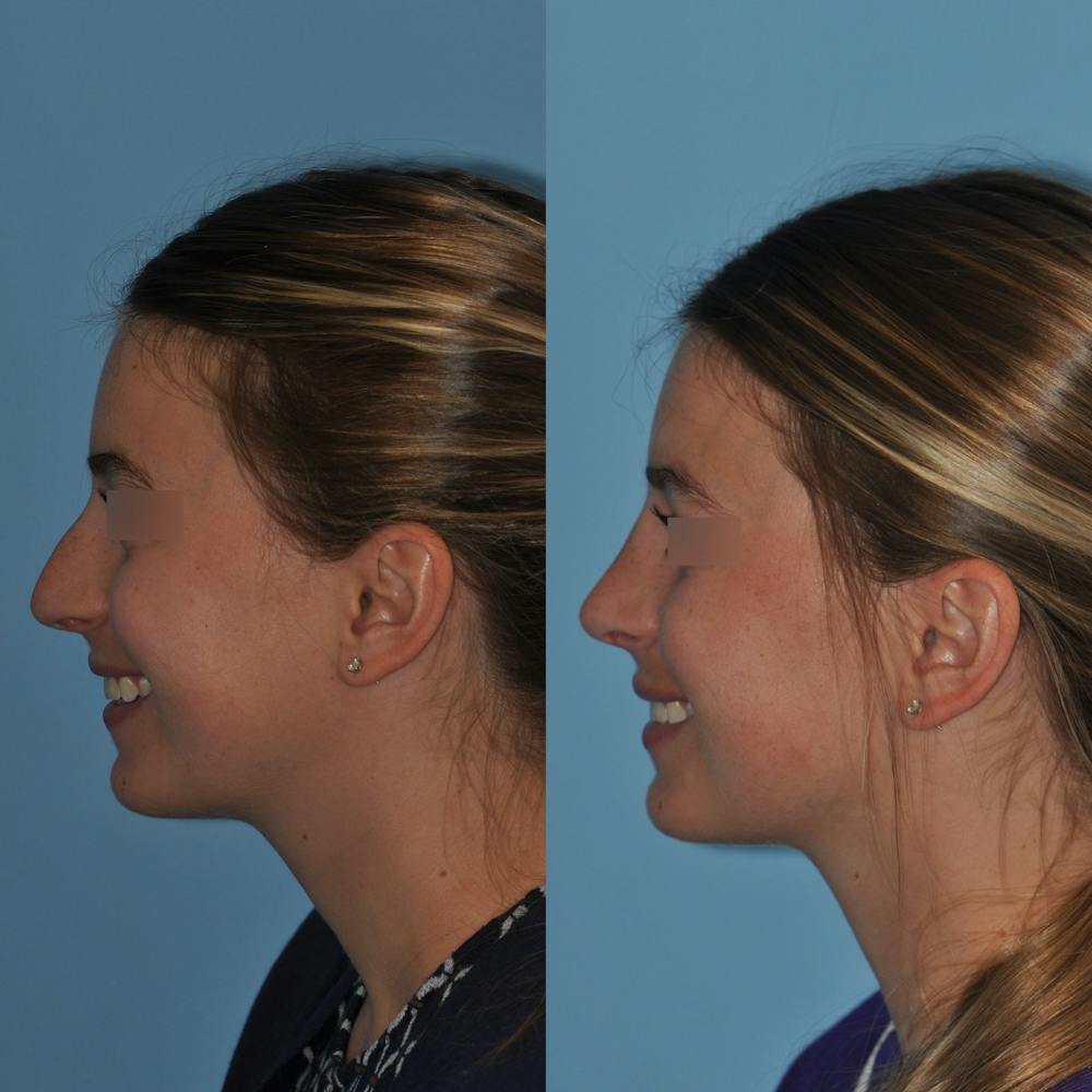 Rhinoplasty Before & After Gallery - Patient 59075280 - Image 5