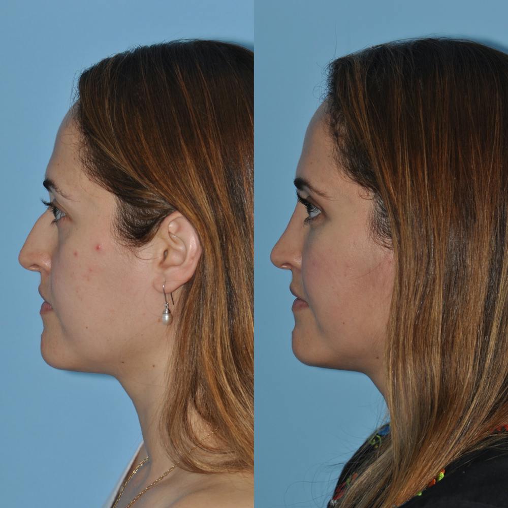 Rhinoplasty Before & After Gallery - Patient 59075281 - Image 3