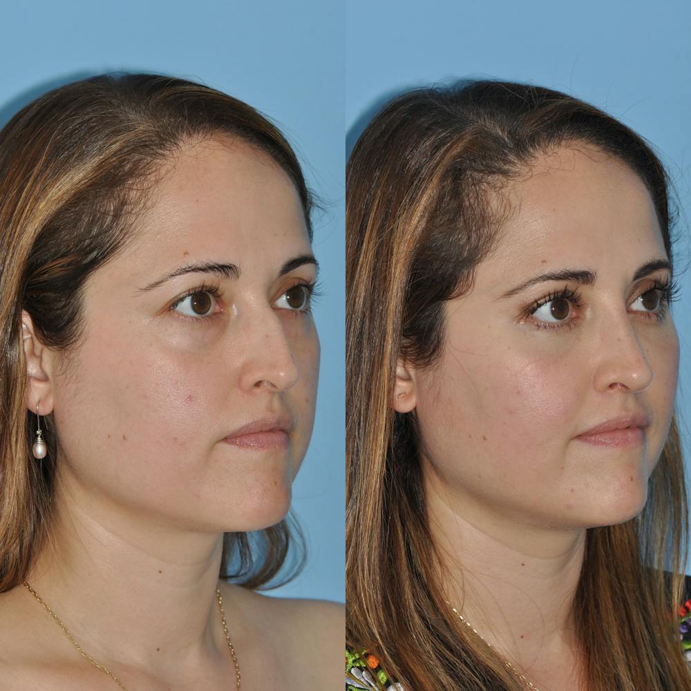 Rhinoplasty Before & After Gallery - Patient 59075281 - Image 4
