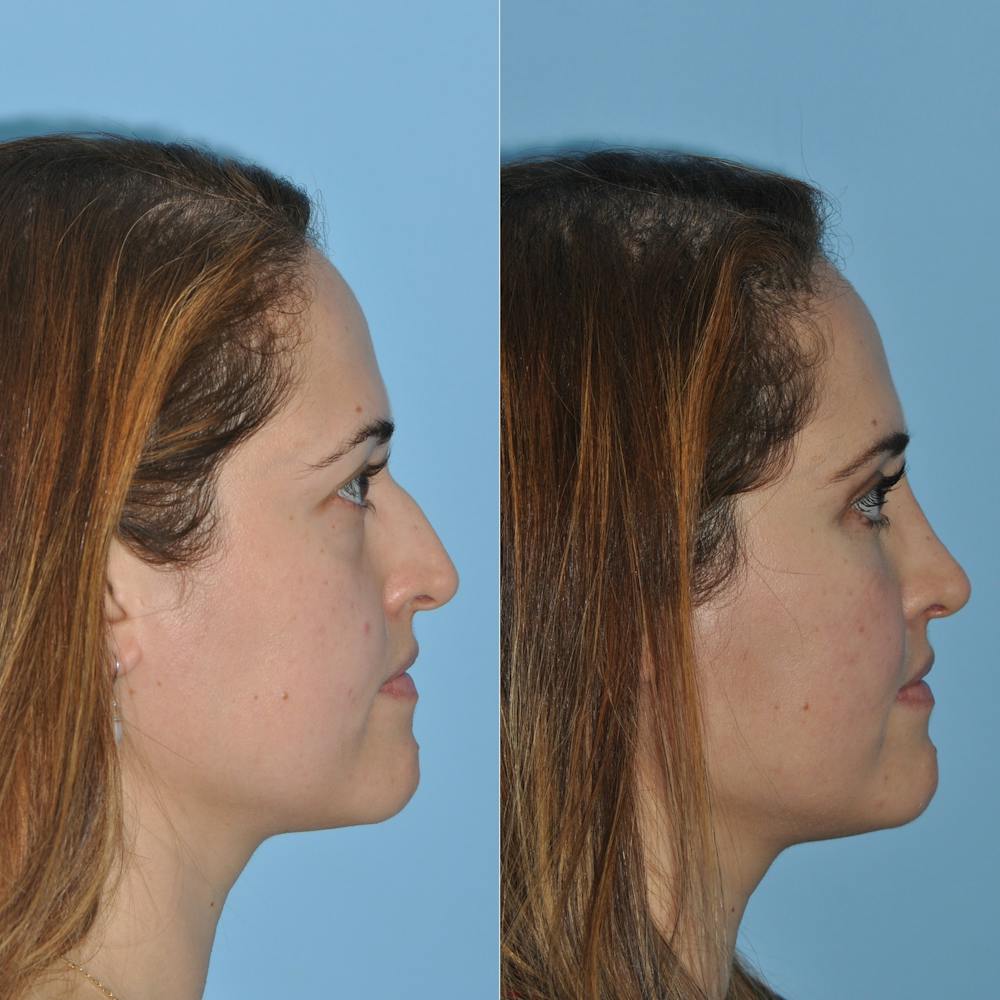 Rhinoplasty Before & After Gallery - Patient 59075281 - Image 5