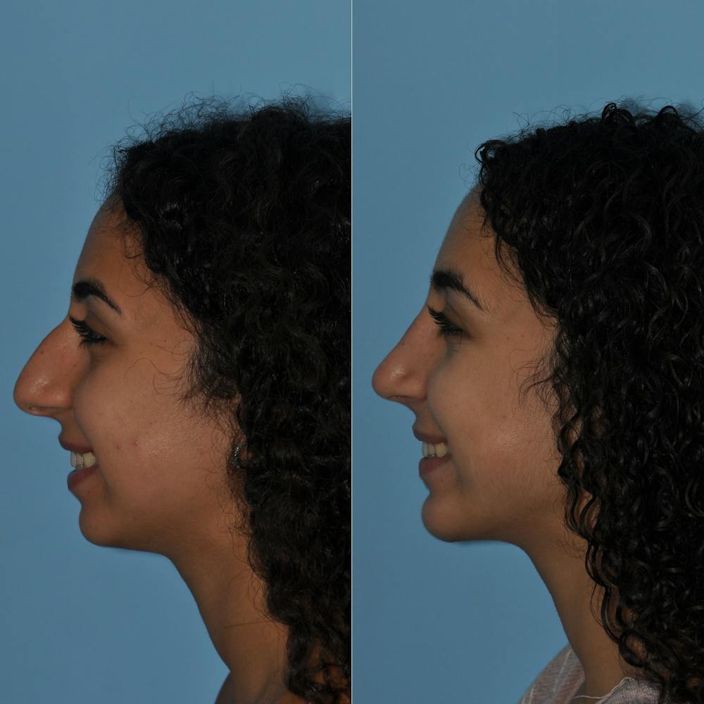 Rhinoplasty Before & After Gallery - Patient 59075282 - Image 3