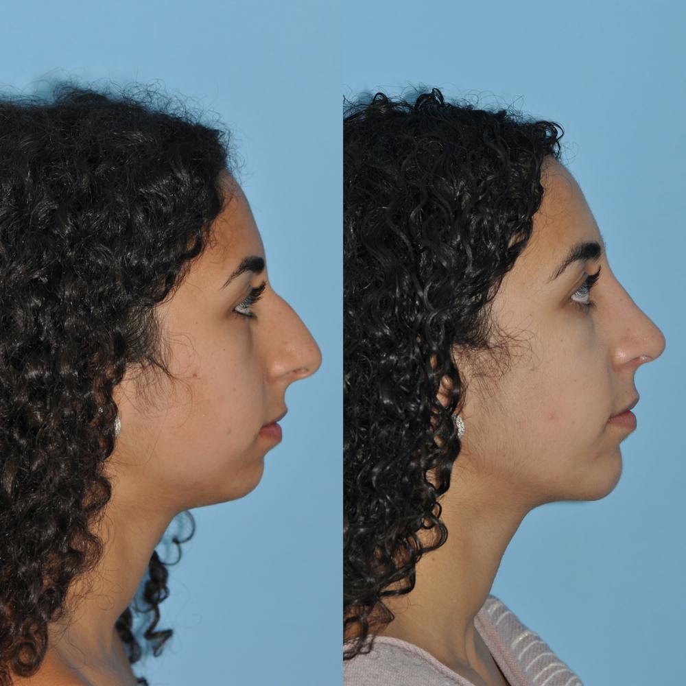 Rhinoplasty Before & After Gallery - Patient 59075282 - Image 4