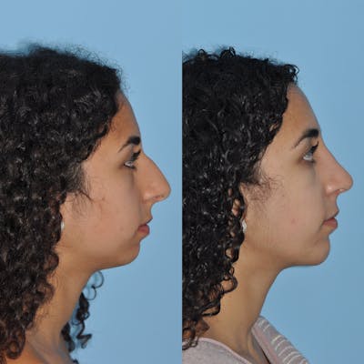 Rhinoplasty Before & After Gallery - Patient 59075282 - Image 4