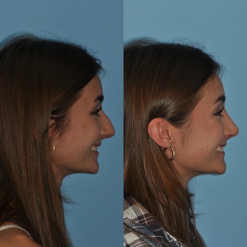 Rhinoplasty Before & After Gallery - Patient 59075283 - Image 1