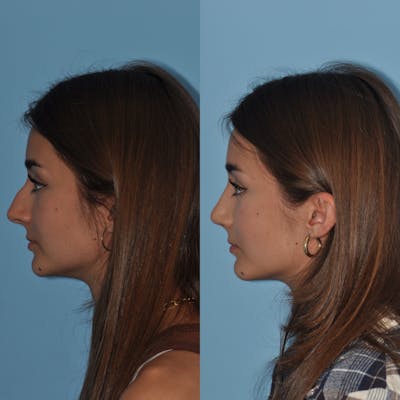 Rhinoplasty Before & After Gallery - Patient 59075283 - Image 2
