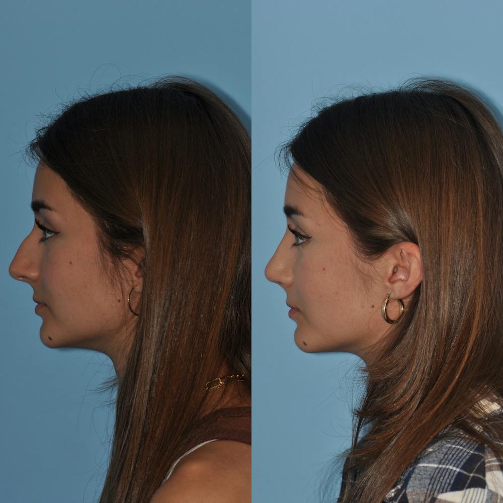 Rhinoplasty Before & After Gallery - Patient 59075283 - Image 2