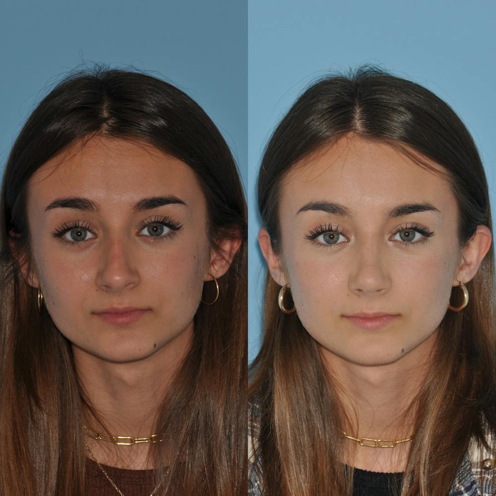 Rhinoplasty Before & After Gallery - Patient 59075283 - Image 4