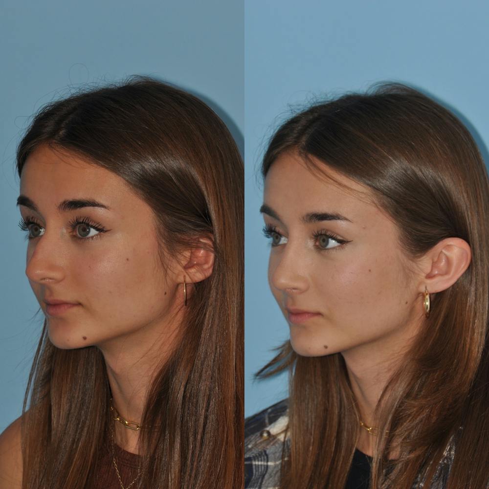 Rhinoplasty Before & After Gallery - Patient 59075283 - Image 5
