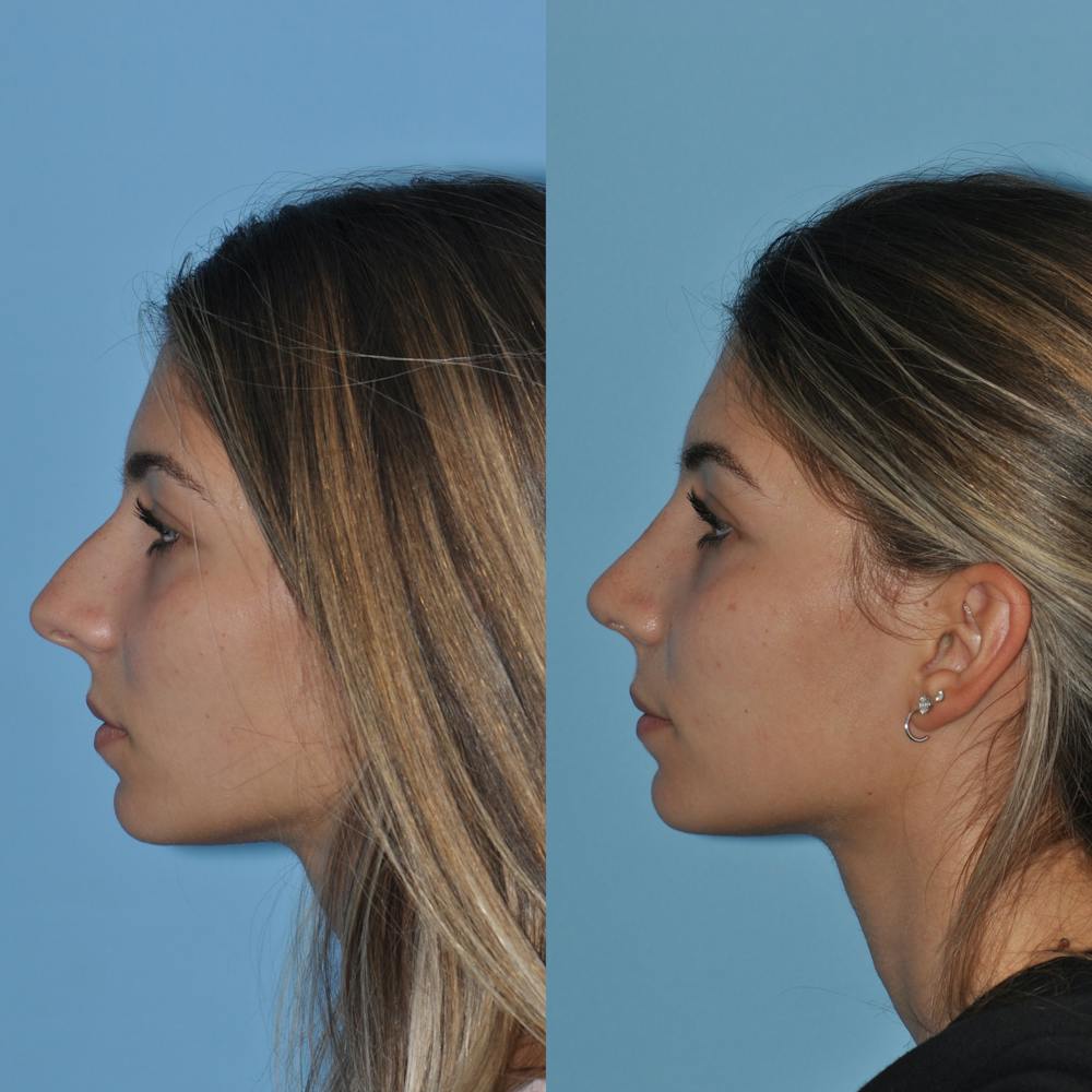 Rhinoplasty Before & After Gallery - Patient 59075284 - Image 1