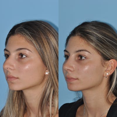 Rhinoplasty Before & After Gallery - Patient 59075284 - Image 2