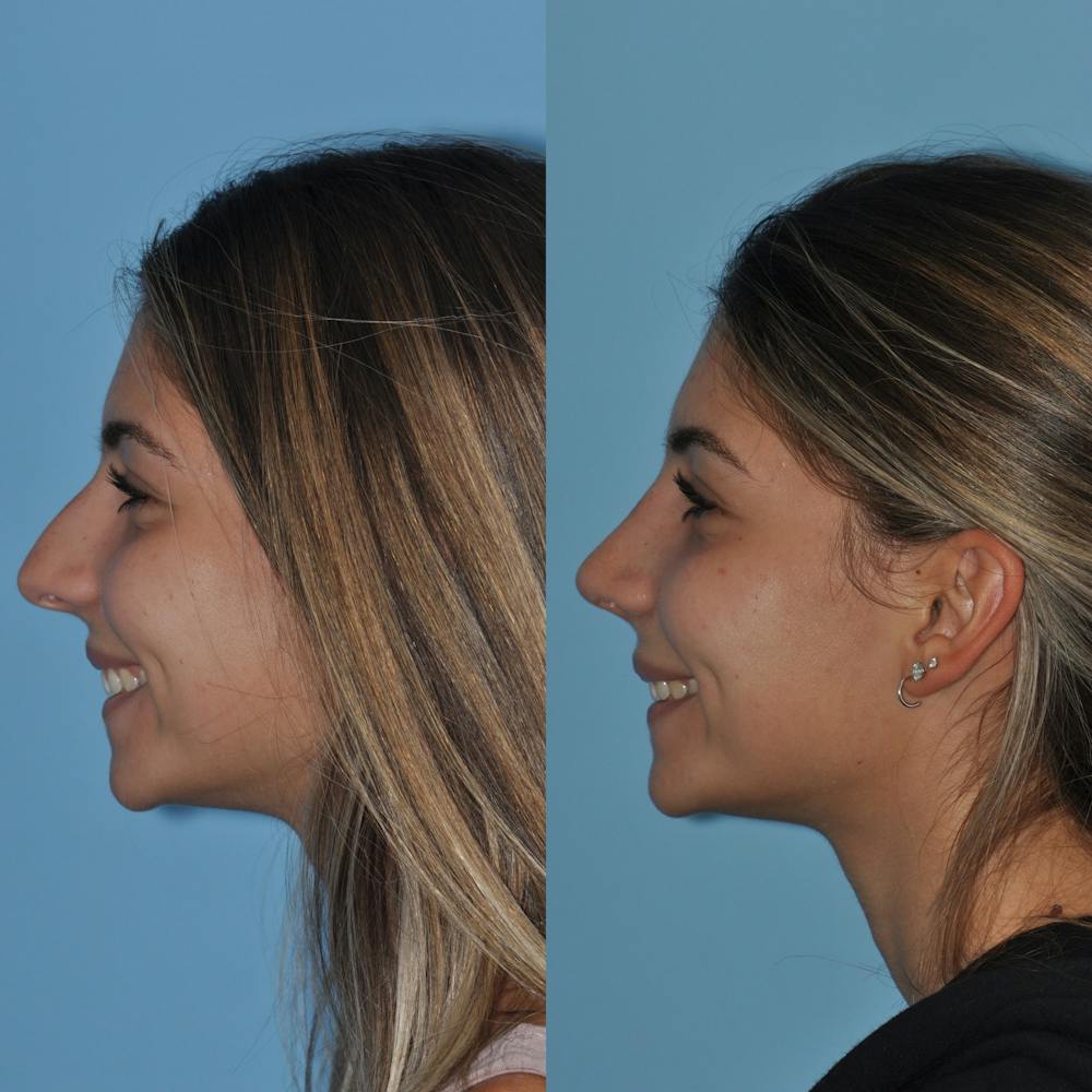 Rhinoplasty Before & After Gallery - Patient 59075284 - Image 3