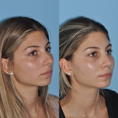 Rhinoplasty Before & After Gallery - Patient 59075284 - Image 4