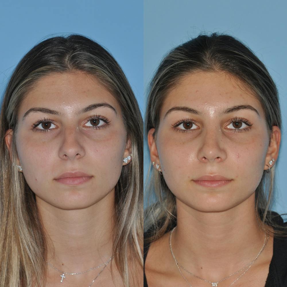 Rhinoplasty Before & After Gallery - Patient 59075284 - Image 5