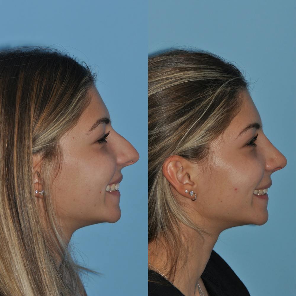 Rhinoplasty Before & After Gallery - Patient 59075284 - Image 6