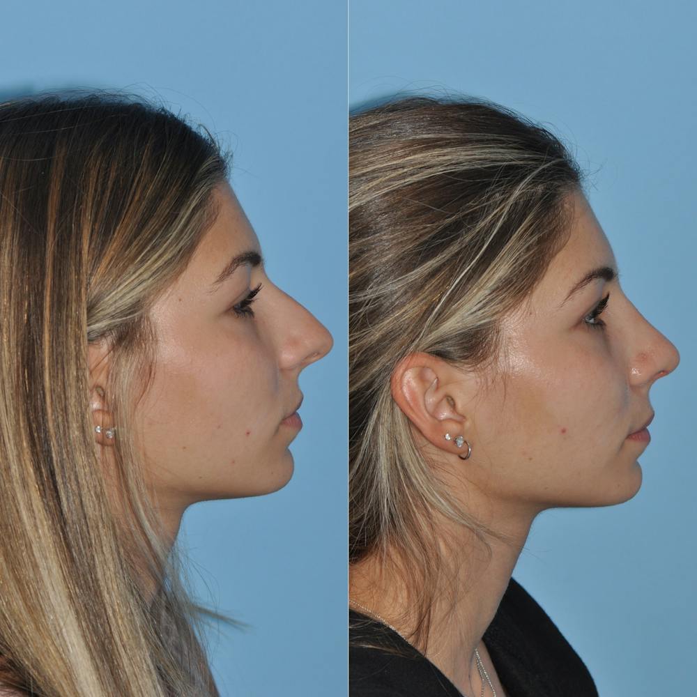 Rhinoplasty Before & After Gallery - Patient 59075284 - Image 7