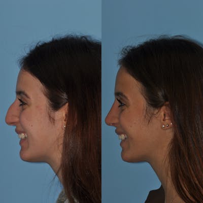 Rhinoplasty Before & After Gallery - Patient 59075285 - Image 1