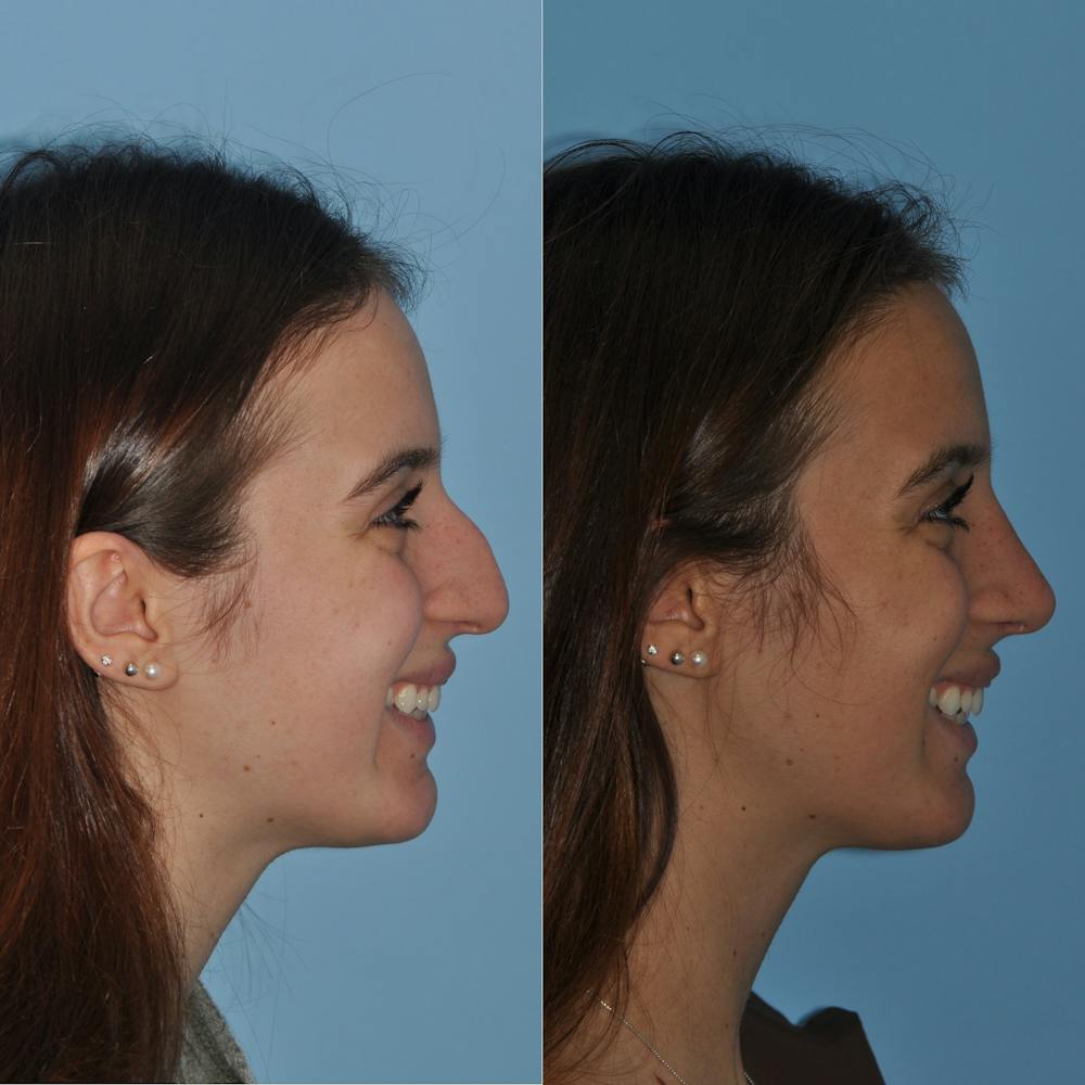 Rhinoplasty Before & After Gallery - Patient 59075285 - Image 2