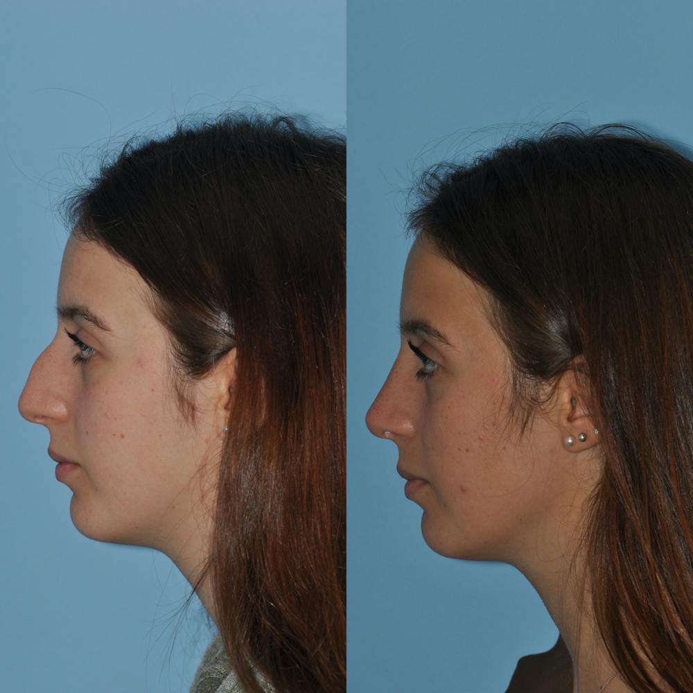 Rhinoplasty Before & After Gallery - Patient 59075285 - Image 3